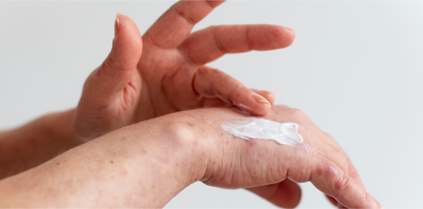 person applying medical cream to hand