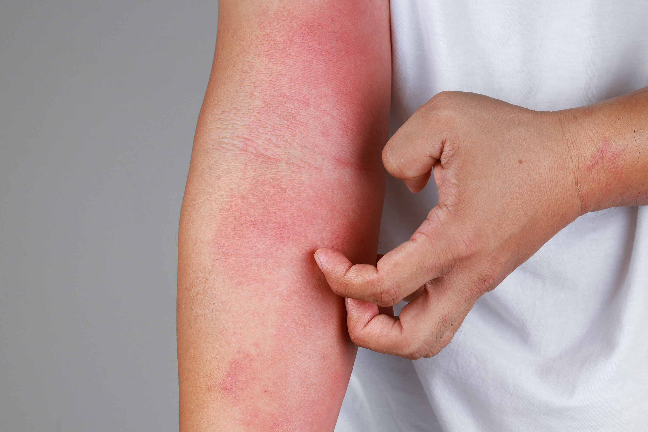 A close-up of bad psoriasis on a person's arm